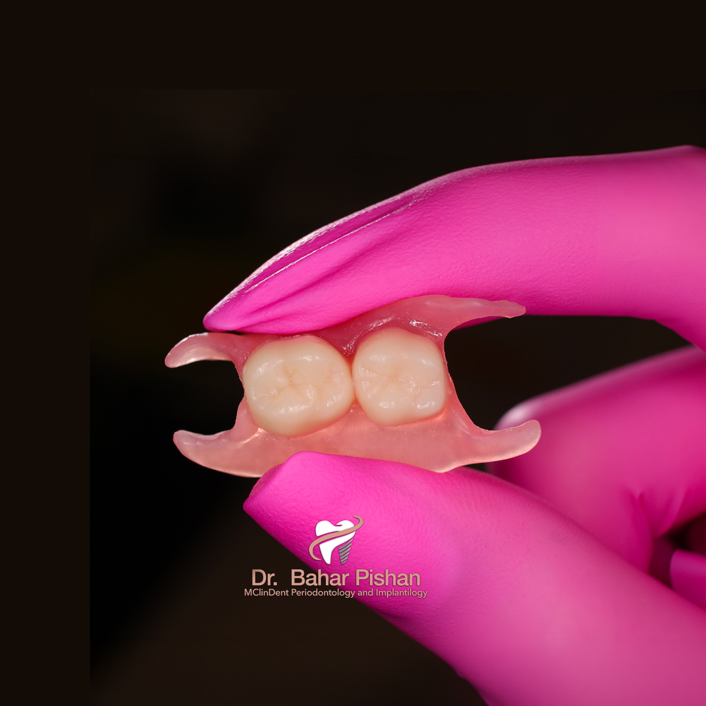 Teilprothese (flexible Versorgung)