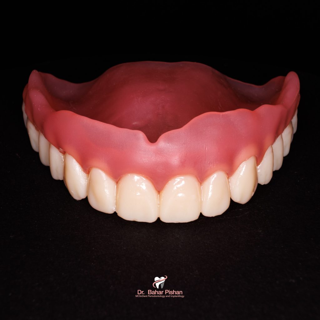 Digitale Totalprothese (Oberkiefer)