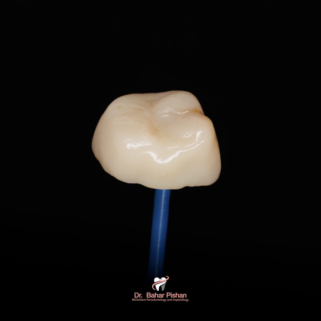 Zahnkrone (ästhetische Vollversorgung)